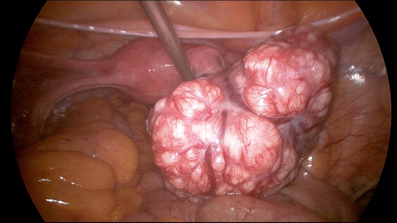 Laparoscopic Myomectomy Atypical Fibroid 1 Laparoscopic Myomectomy Atypical Fibroid 1